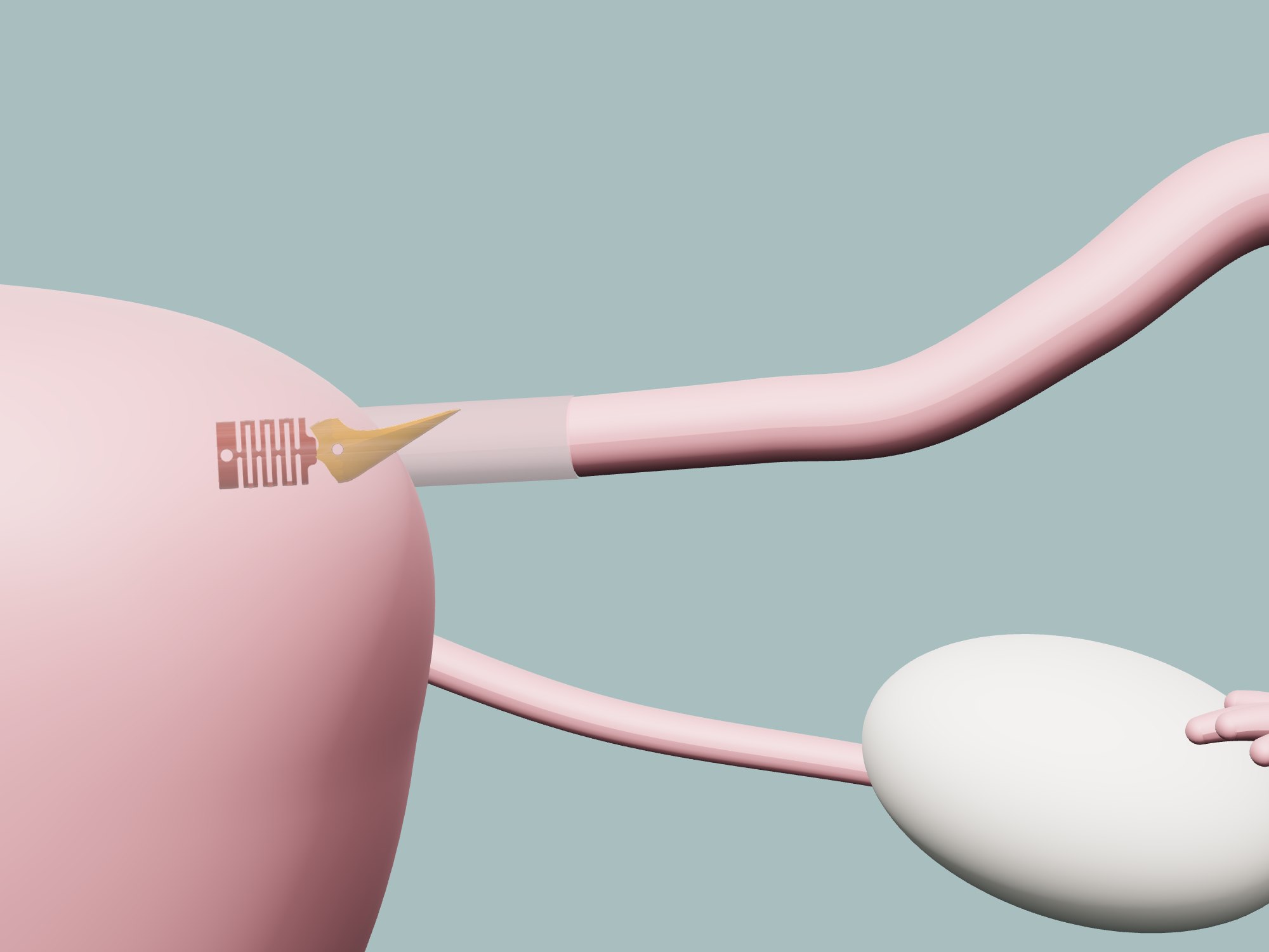 Rendering of a Choice valve inside the fallopian tube