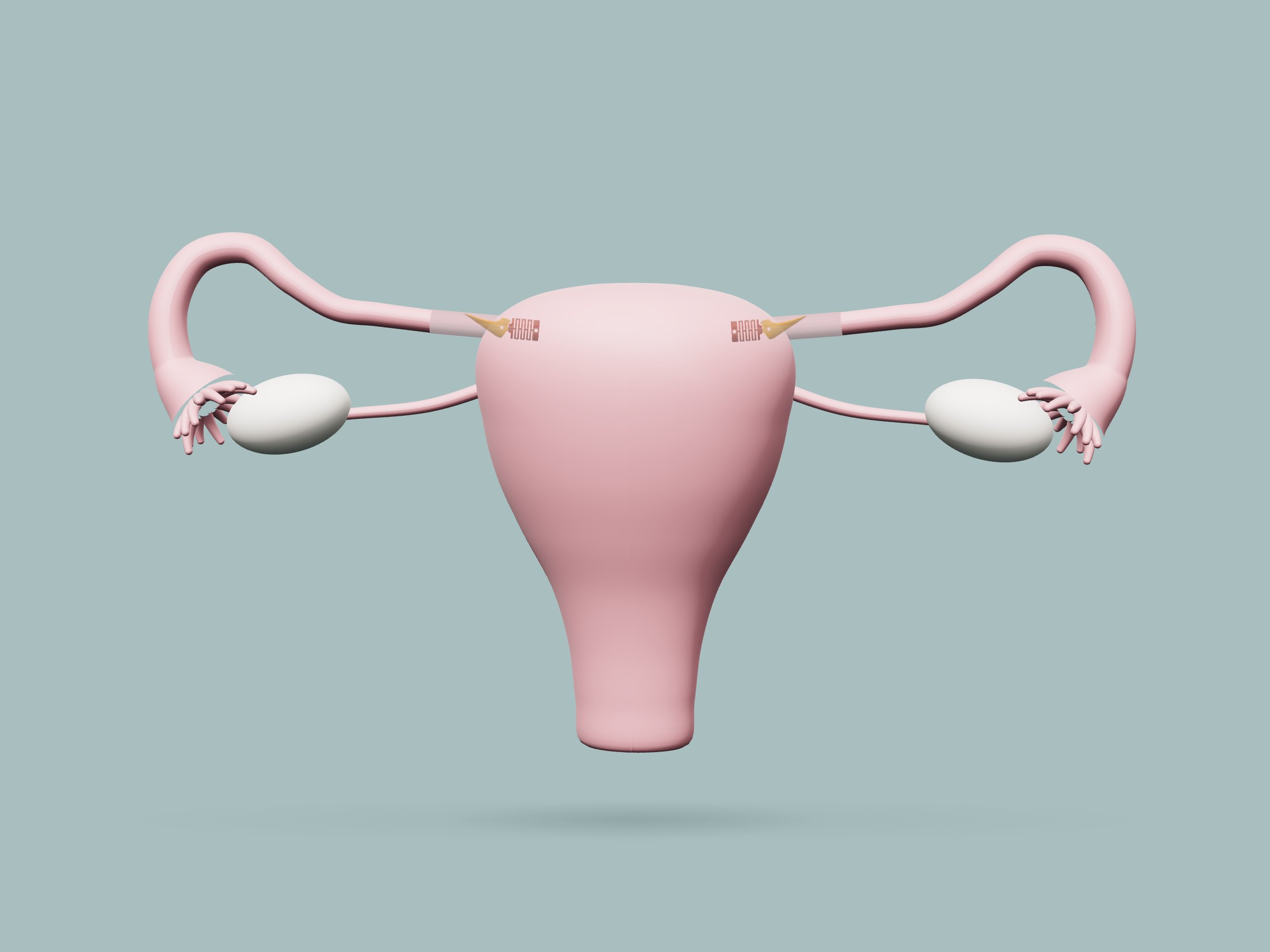 Rendering of the uterus and fallopian tubes, with a Choice valve at the start of each tube